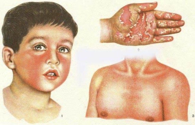 Детские заболевания которые плохо переносят взрослые