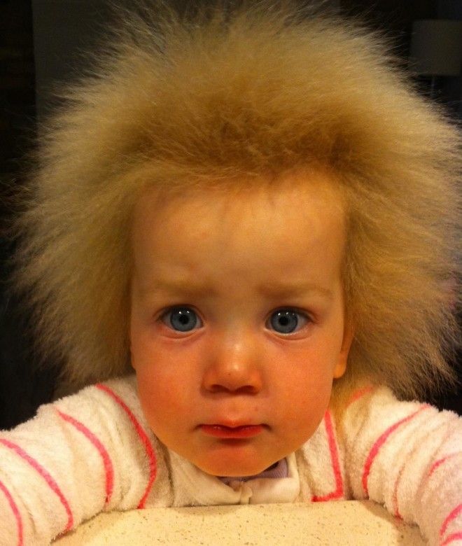 Изза генетической аномалии девочка не может расчесать свои волосы