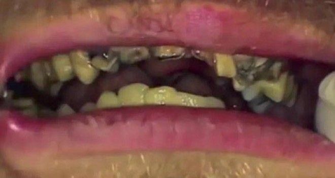 LВот как будут выглядеть зубы если не чистить их 20 лет