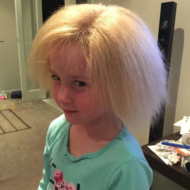 Изза генетической аномалии девочка не может расчесать свои волосы