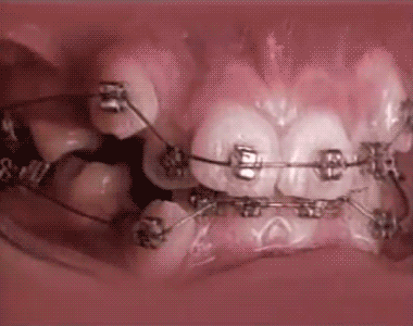 процесс коррекции зубов при помощи брекетов