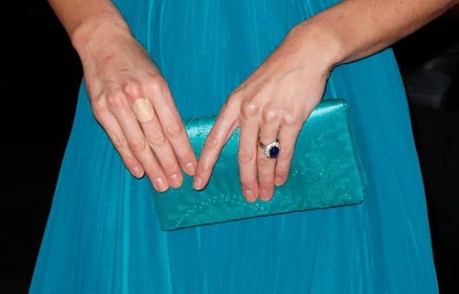 SПочему Кейт Мидлтон так часто вынуждена заклеивать пальцы пластырем