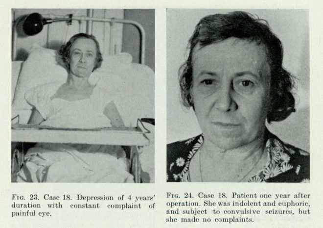 Золотая эра лоботомии фотографии пациентов до и после