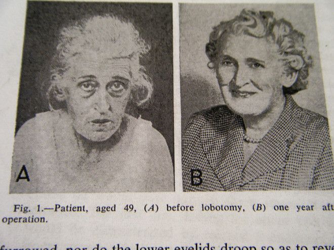 Золотая эра лоботомии фотографии пациентов до и после