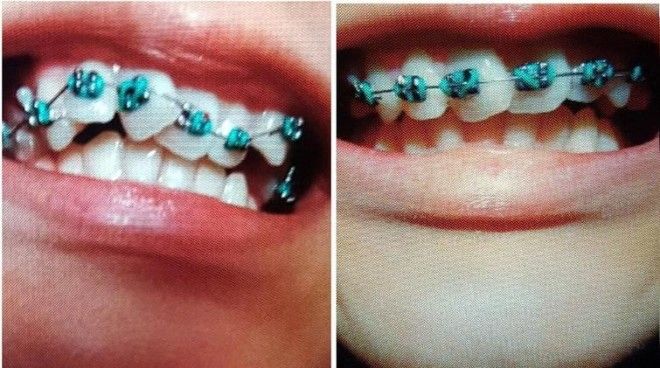 Lюди выставляют фото до и после и тут всё от похудения до исправления зубов