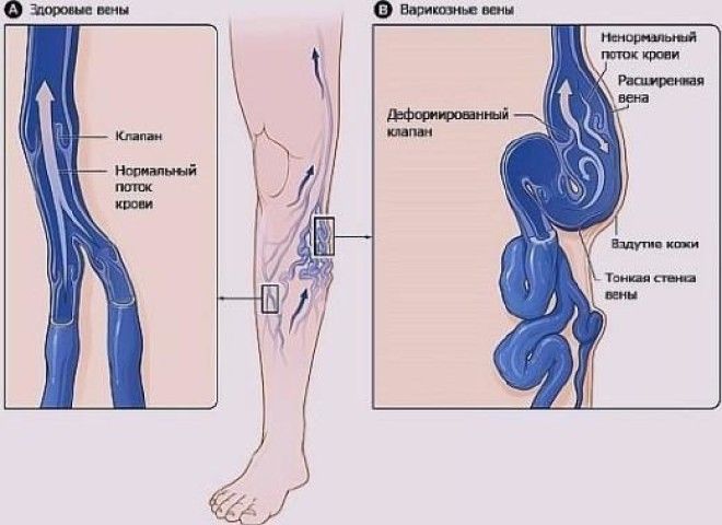 Полезные советы для лечения варикоза.